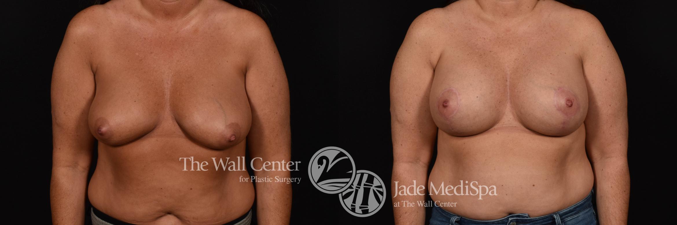Breast Augmentation with Lift & SAFELipo Front Photo, Shreveport, Louisiana, The Wall Center for Plastic Surgery, Case 957