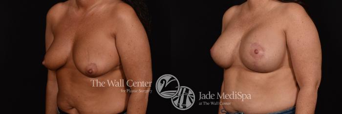 Breast Augmentation with Lift & SAFELipo Left Oblique Photo, Shreveport, Louisiana, The Wall Center for Plastic Surgery, Case 957