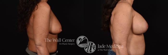 Breast Augmentation with Lift & SAFELipo Right Side Photo, Shreveport, Louisiana, The Wall Center for Plastic Surgery, Case 957