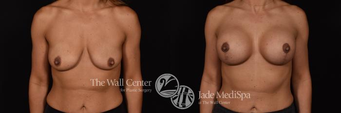 Breast Aug with Lift Front Photo, Shreveport, Louisiana, The Wall Center for Plastic Surgery, Case 959