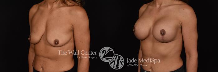 Breast Aug with Lift Left Oblique Photo, Shreveport, Louisiana, The Wall Center for Plastic Surgery, Case 959
