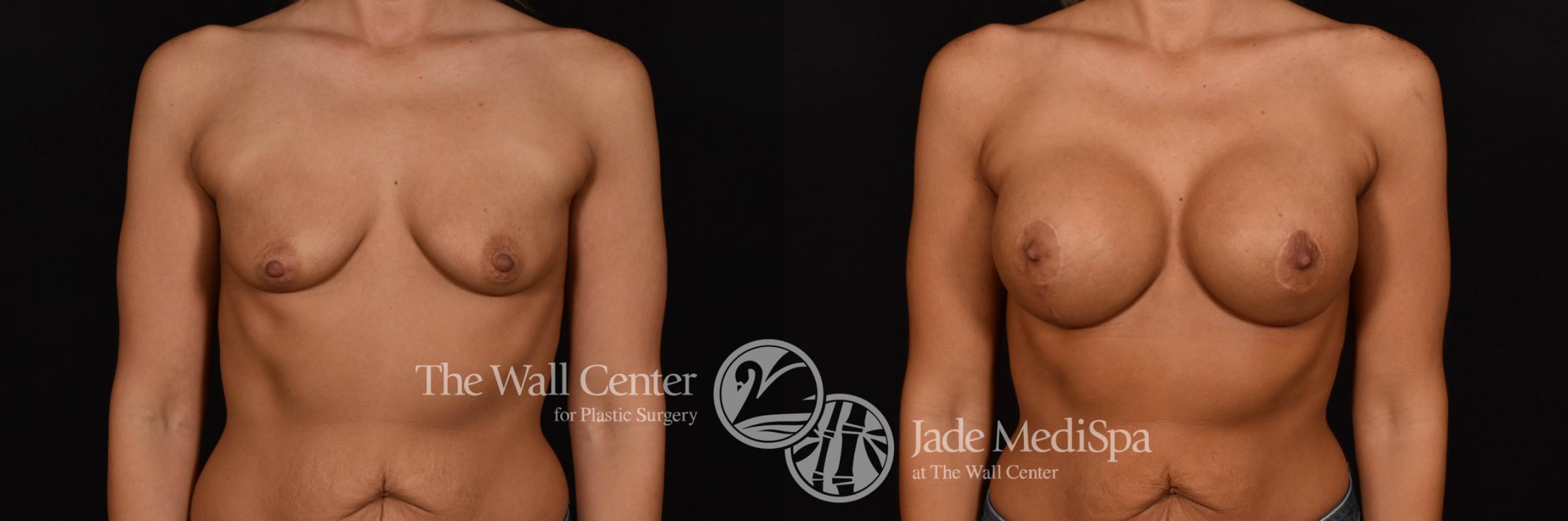 Breast Augmentation with Lift Front Photo, Shreveport, Louisiana, The Wall Center for Plastic Surgery, Case 967