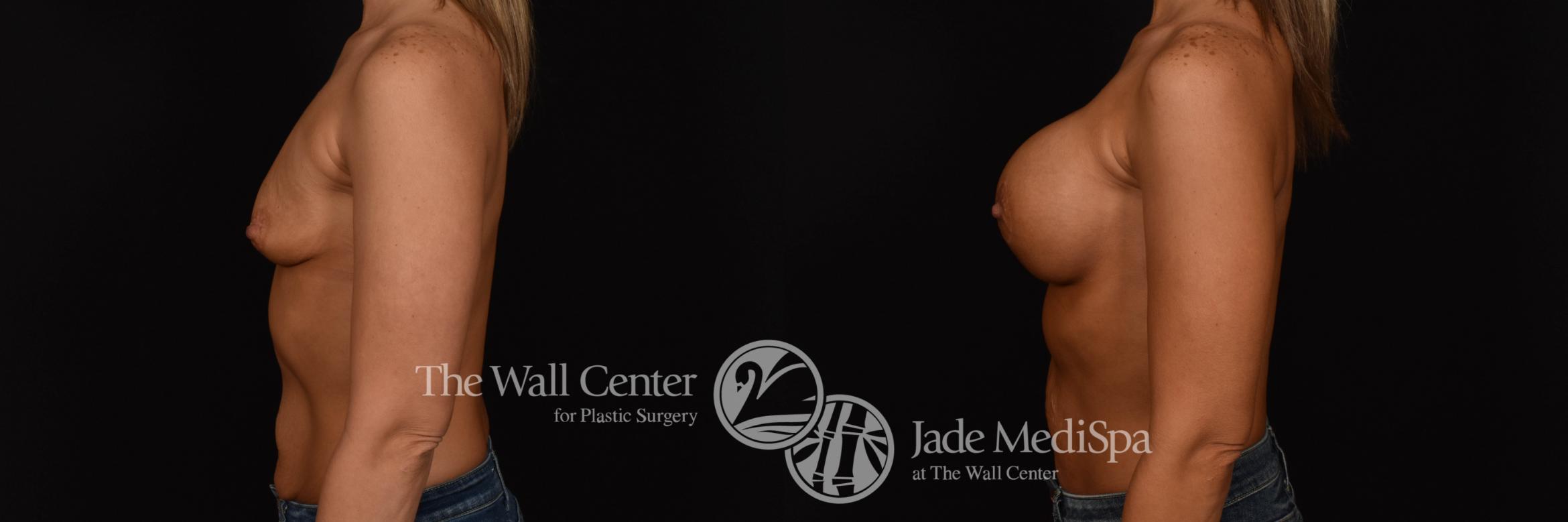 Breast Augmentation with Lift Left Side Photo, Shreveport, Louisiana, The Wall Center for Plastic Surgery, Case 967