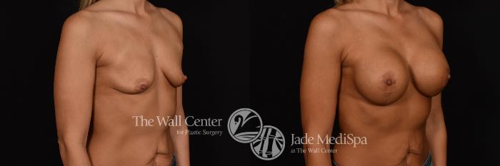 Breast Augmentation with Lift Right Oblique Photo, Shreveport, Louisiana, The Wall Center for Plastic Surgery, Case 967