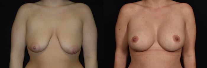 10 Years Post-Op Breast Augmentation with Lift