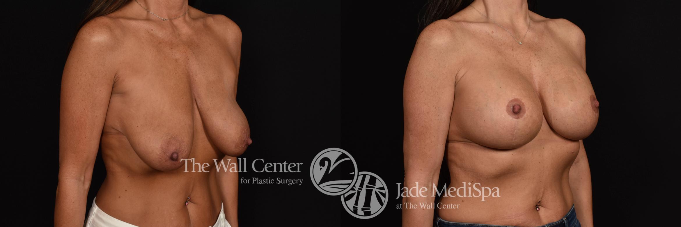 Before & After Breast Augmentation with Lift Case 984 Right Oblique View in Shreveport, LA