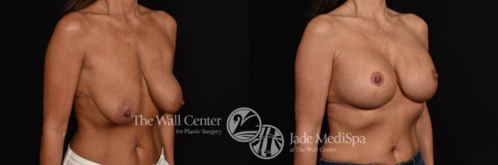 Before & After Breast Augmentation with Lift Case 984 Right Oblique View in Shreveport, LA