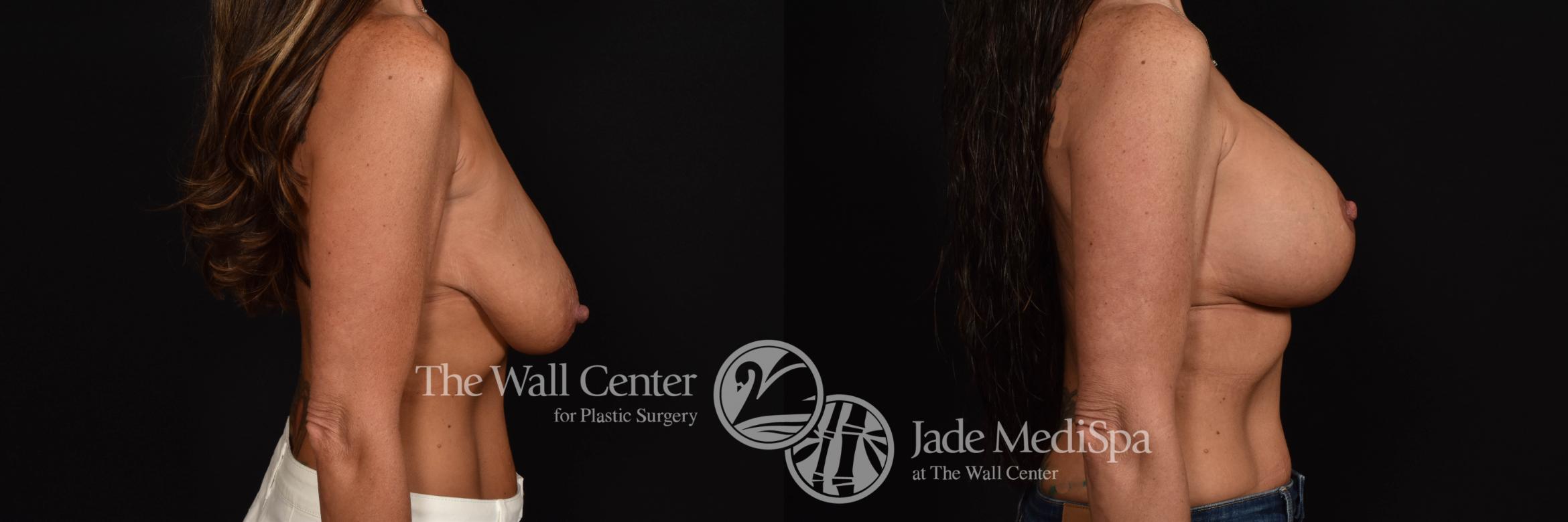 Before & After Breast Augmentation with Lift Case 984 Right Side View in Shreveport, LA