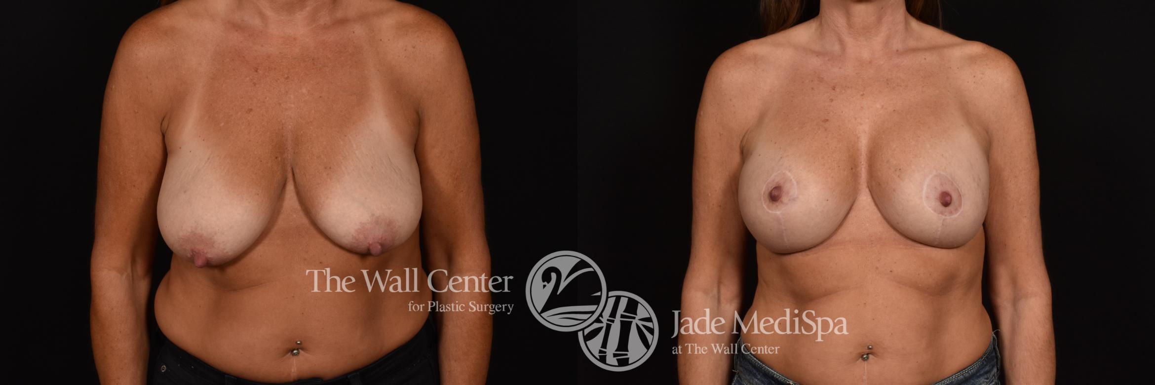 Before & After Breast Augmentation with Lift Case 994 Front View in Shreveport, LA