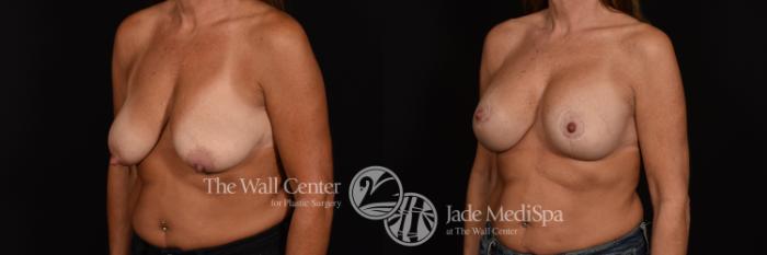 Before & After Breast Augmentation with Lift Case 994 Left Oblique View in Shreveport, LA