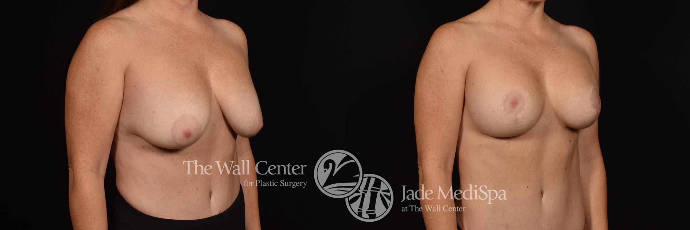 Before & After Breast Implant Exchange Case 1008 Right Oblique View in Shreveport, LA