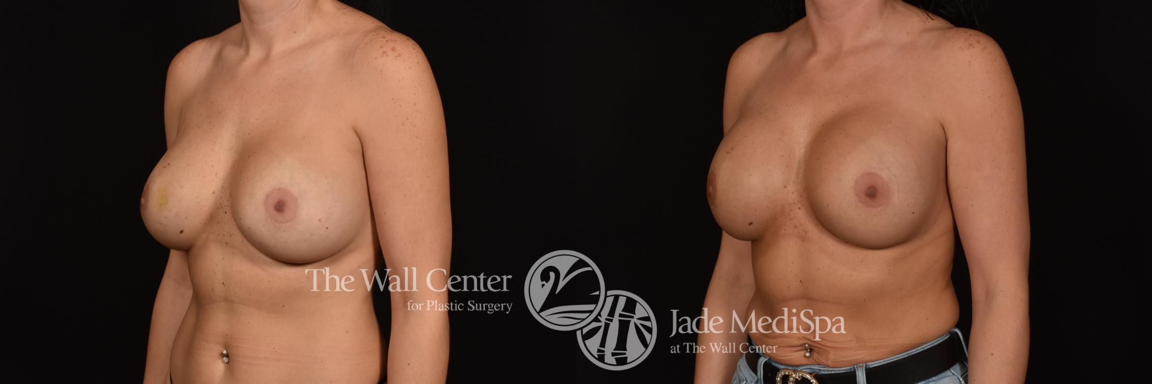 Before & After Breast Implant Exchange Case 1044 Left Oblique View in Shreveport, LA