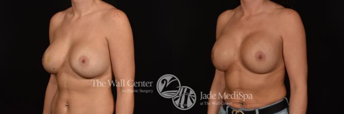 Before & After Breast Implant Exchange Case 1044 Left Oblique View in Shreveport, LA