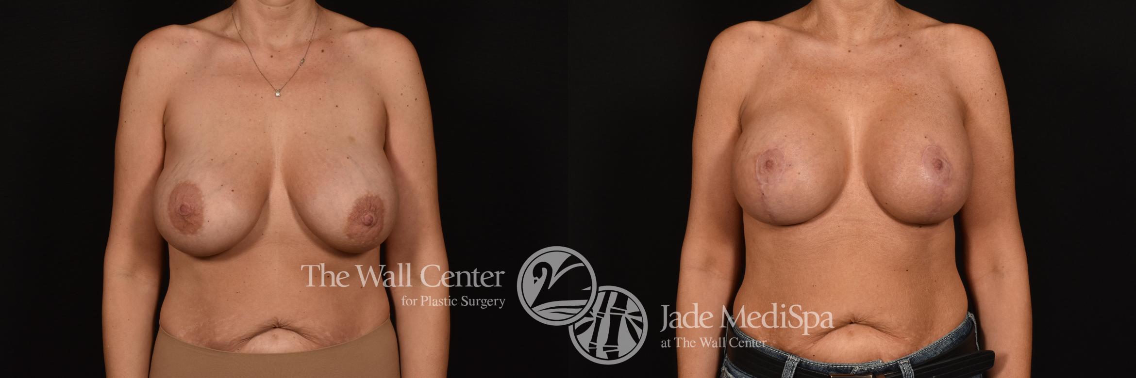 Before & After Breast Implant Exchange Case 1082 Front View in Shreveport, LA