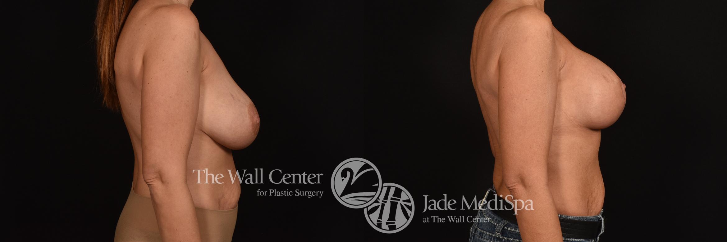 Before & After Breast Implant Exchange Case 1082 Right Side View in Shreveport, LA