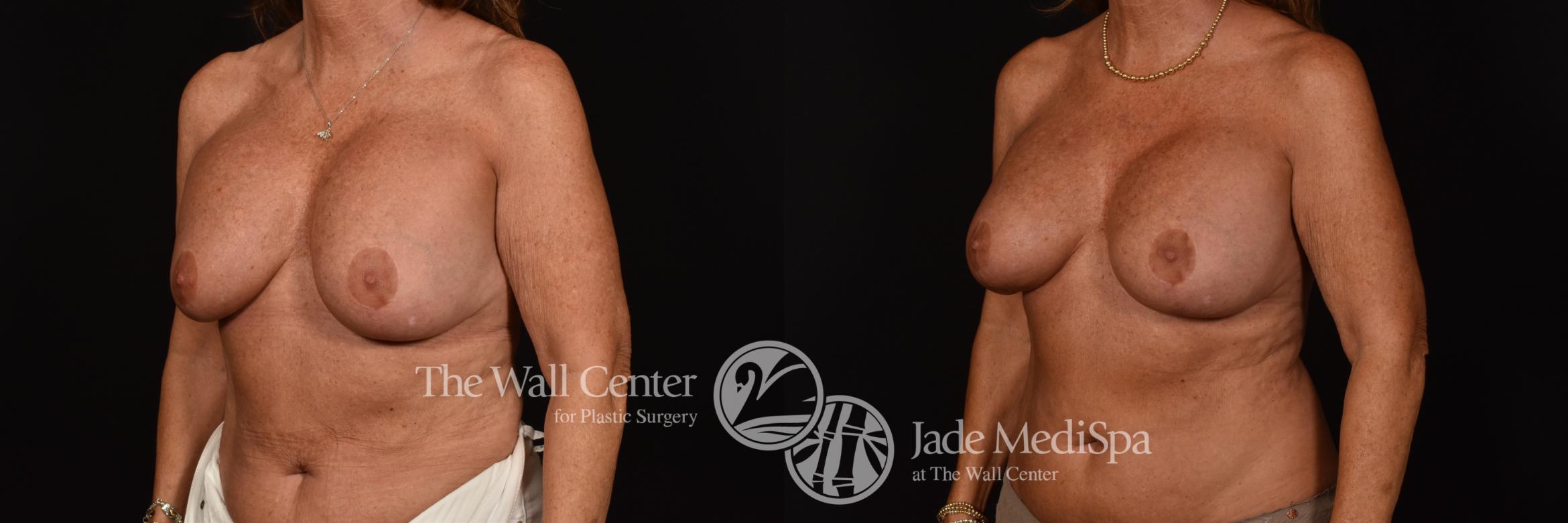 Before & After Breast Implant Exchange Case 1101 Left Oblique View in Shreveport, LA