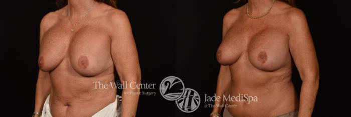 Before & After Breast Implant Exchange Case 1101 Left Oblique View in Shreveport, LA