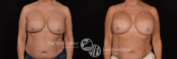 Before & After Breast Implant Exchange Case 1132 Front View in Shreveport, LA