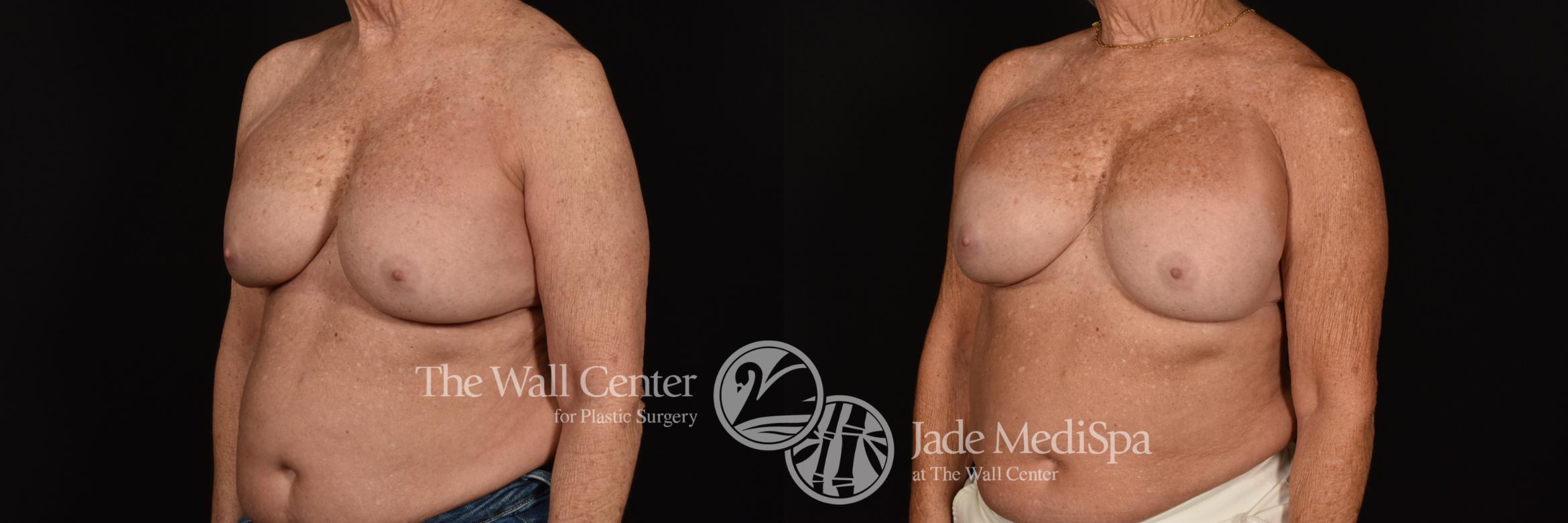 Before & After Breast Implant Exchange Case 1132 Left Oblique View in Shreveport, LA
