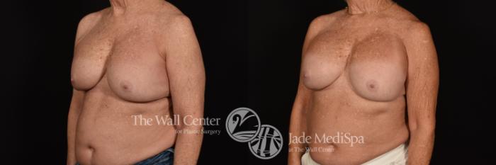 Before & After Breast Implant Exchange Case 1132 Left Oblique View in Shreveport, LA