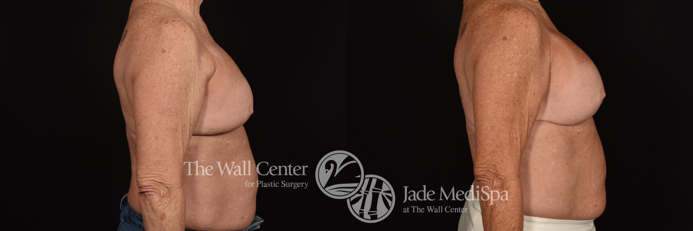 Before & After Breast Implant Exchange Case 1132 Right Side View in Shreveport, LA