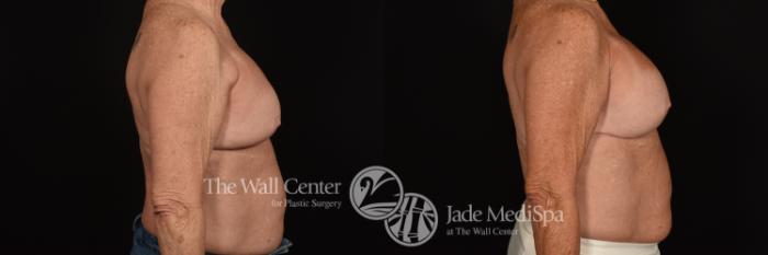 Before & After Breast Implant Exchange Case 1132 Right Side View in Shreveport, LA