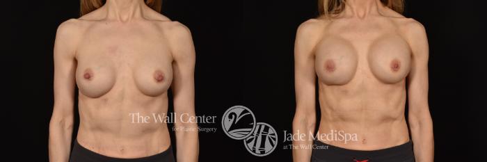 Before & After Breast Implant Exchange Case 1136 Front View in Shreveport, LA