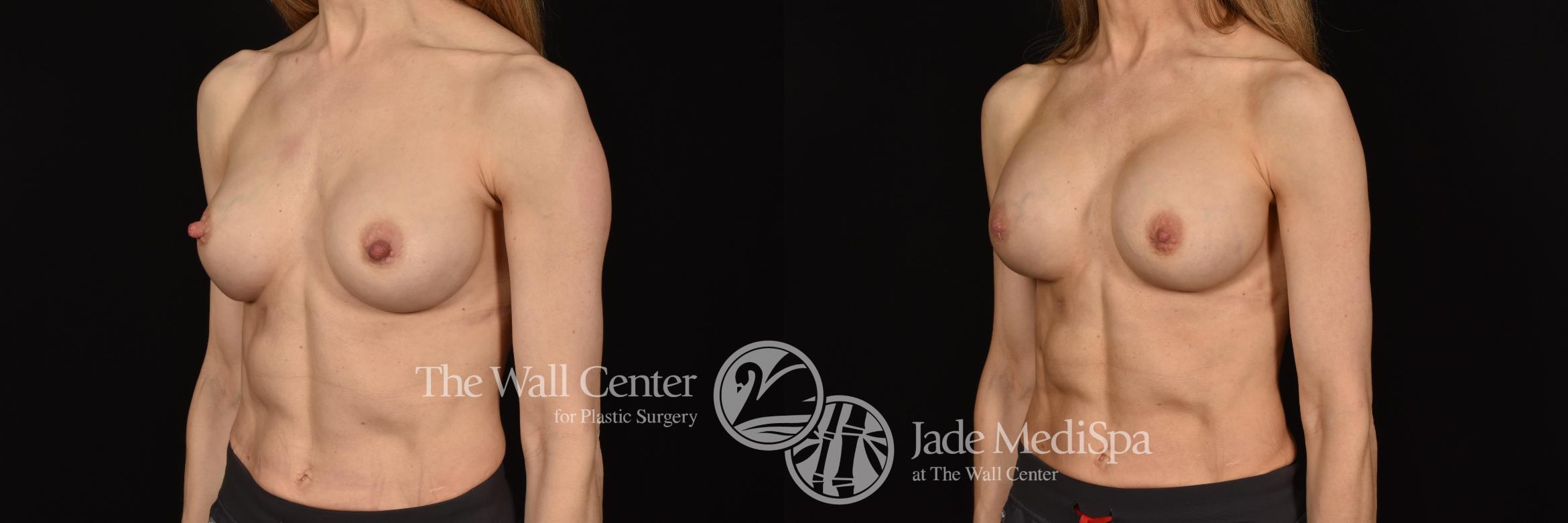 Before & After Breast Implant Exchange Case 1136 Left Oblique View in Shreveport, LA