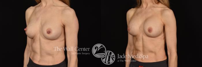 Before & After Breast Implant Exchange Case 1136 Left Oblique View in Shreveport, LA