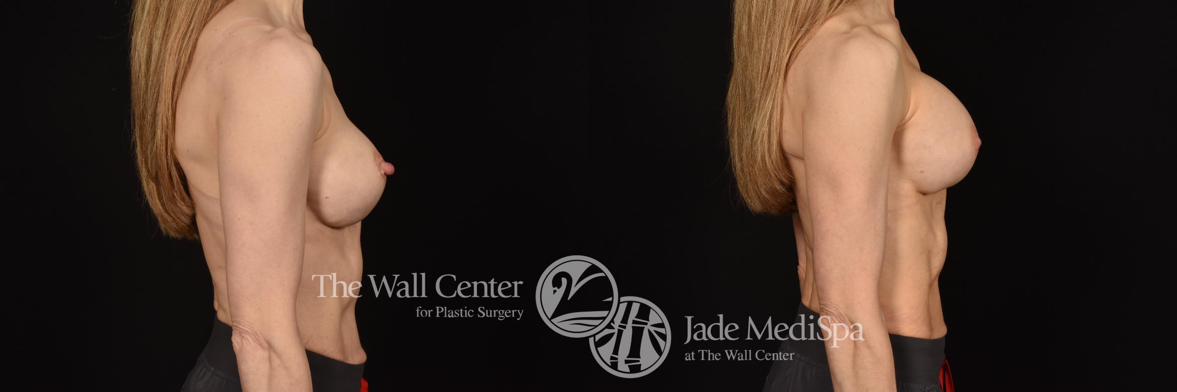 Before & After Breast Implant Exchange Case 1136 Right Side View in Shreveport, LA