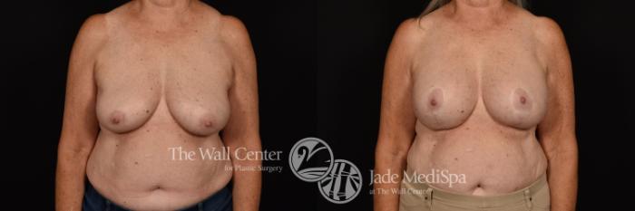 Before & After Breast Implant Exchange Case 1137 Front View in Shreveport, LA