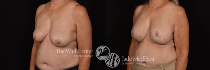 Before & After Breast Implant Exchange Case 1137 Left Oblique View in Shreveport, LA