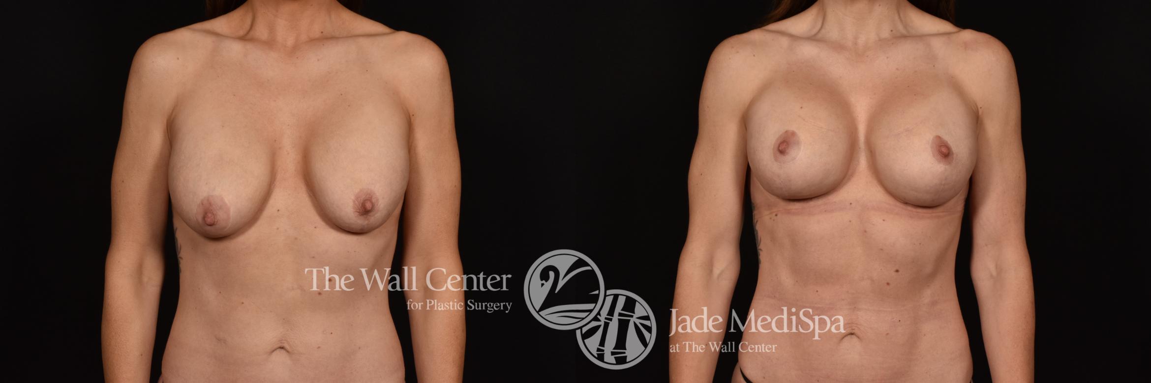 Before & After Breast Implant Exchange Case 1139 Front View in Shreveport, LA