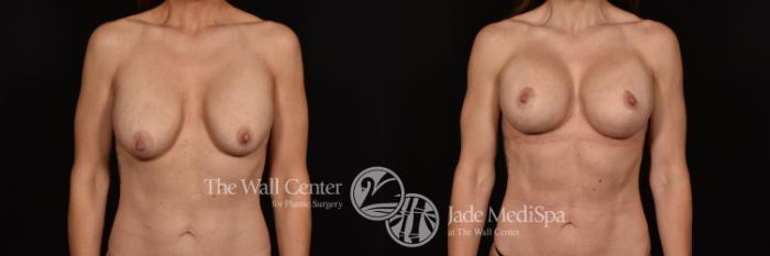 Before & After Breast Implant Exchange Case 1139 Front View in Shreveport, LA