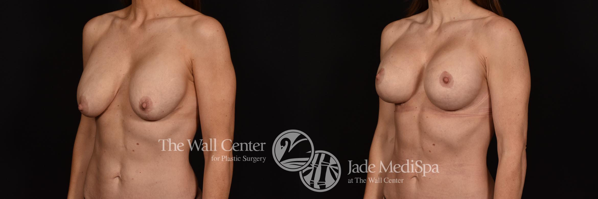 Before & After Breast Implant Exchange Case 1139 Left Oblique View in Shreveport, LA