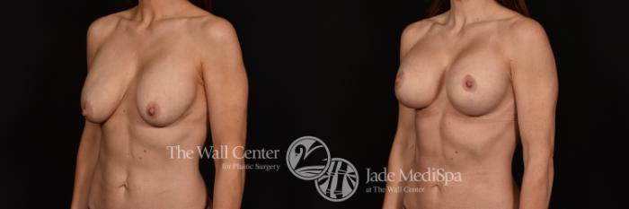 Before & After Breast Implant Exchange Case 1139 Left Oblique View in Shreveport, LA