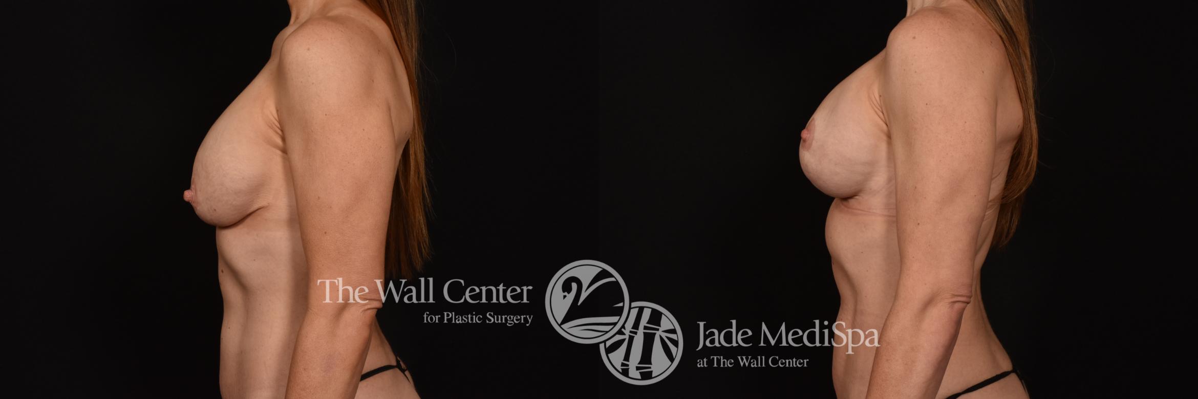 Before & After Breast Implant Exchange Case 1139 Left Side View in Shreveport, LA