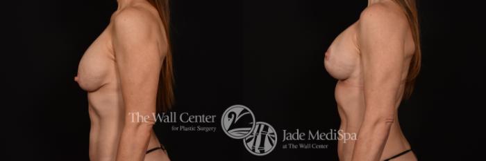 Before & After Breast Implant Exchange Case 1139 Left Side View in Shreveport, LA