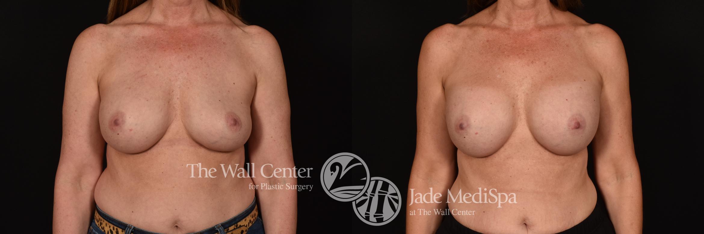 Before & After Breast Implant Exchange Case 1153 Front View in Shreveport, LA