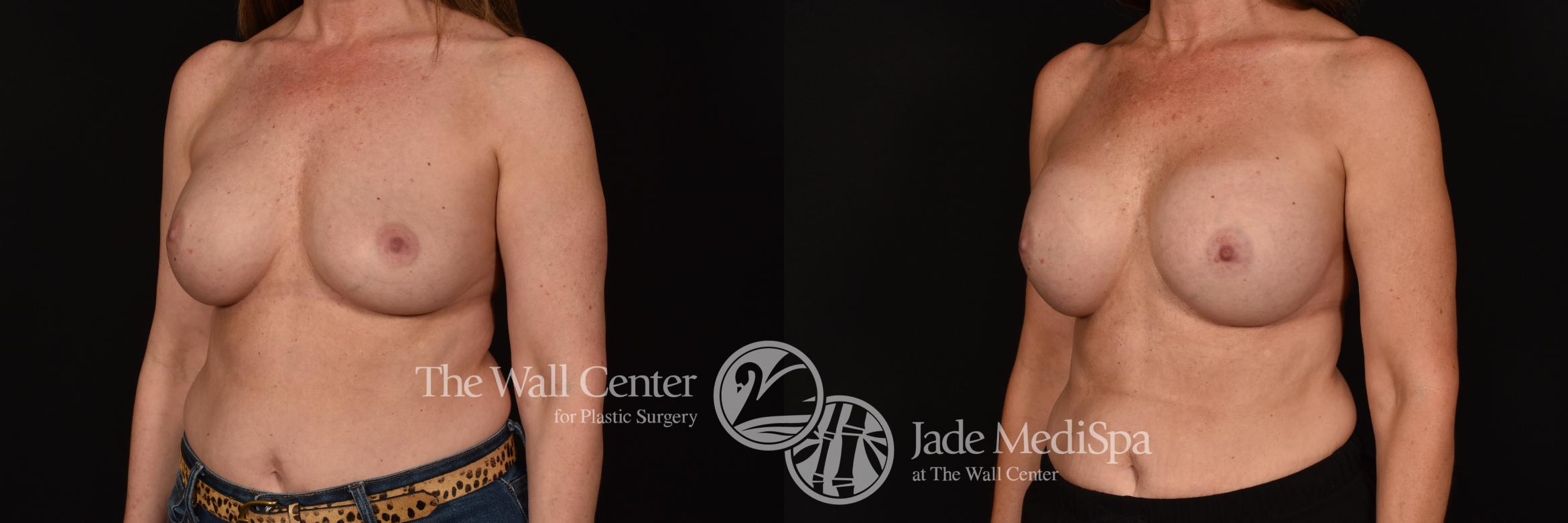 Before & After Breast Implant Exchange Case 1153 Left Oblique View in Shreveport, LA