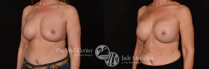 Before & After Breast Implant Exchange Case 1153 Left Oblique View in Shreveport, LA