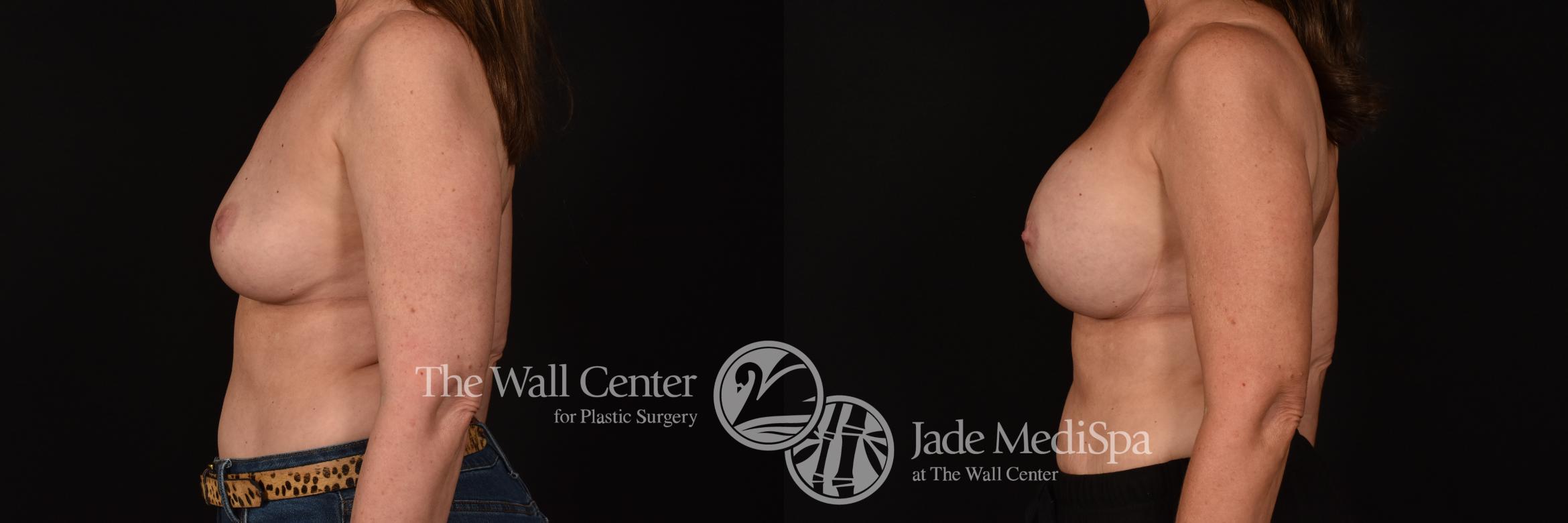 Before & After Breast Implant Exchange Case 1153 Left Side View in Shreveport, LA