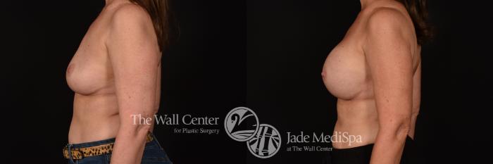 Before & After Breast Implant Exchange Case 1153 Left Side View in Shreveport, LA