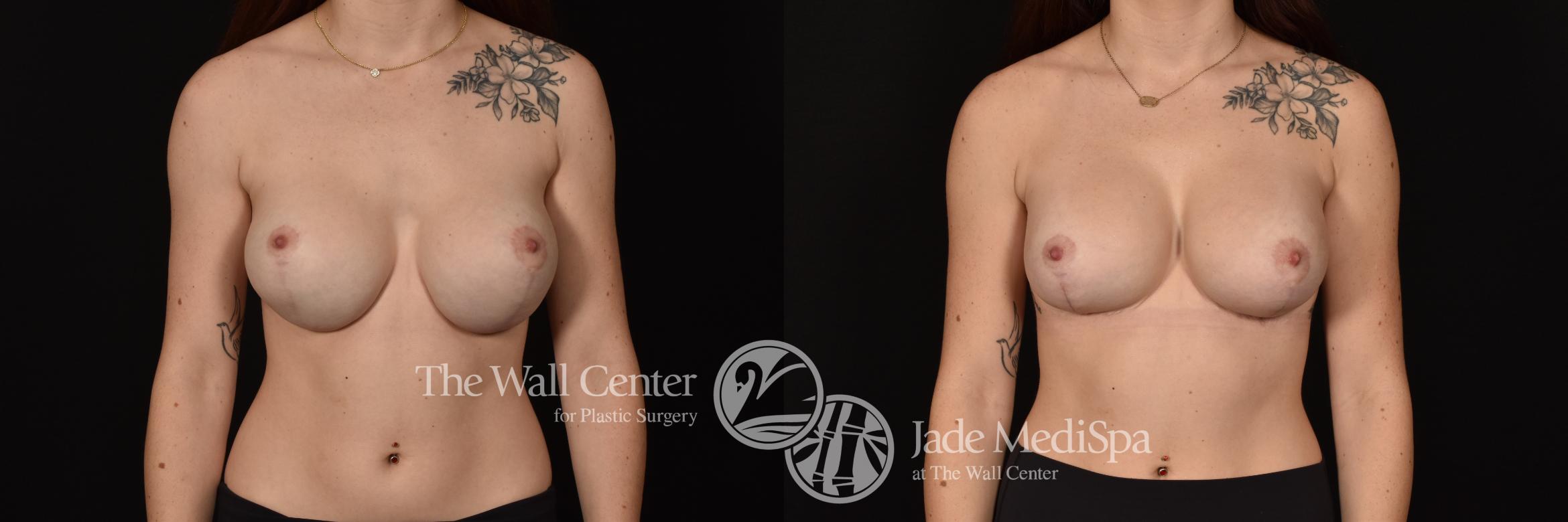 Before & After Breast Implant Exchange Case 1154 Front View in Shreveport, LA