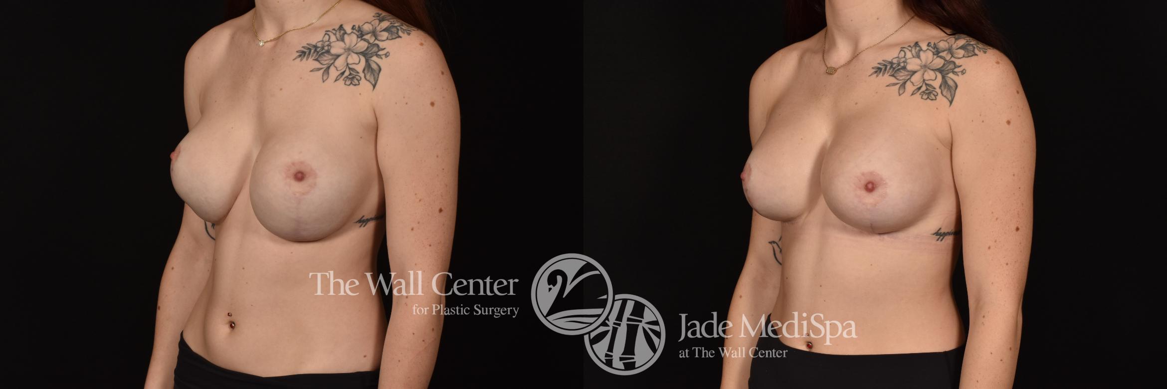 Before & After Breast Implant Exchange Case 1154 Left Oblique View in Shreveport, LA