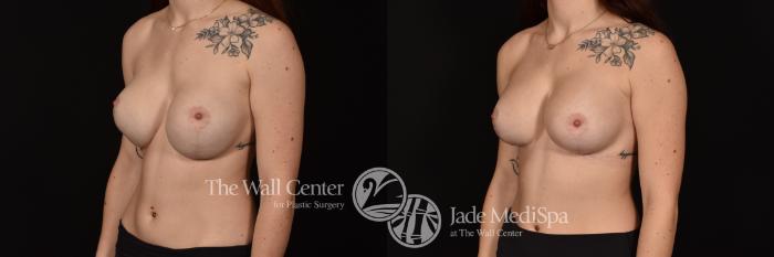 Before & After Breast Implant Exchange Case 1154 Left Oblique View in Shreveport, LA
