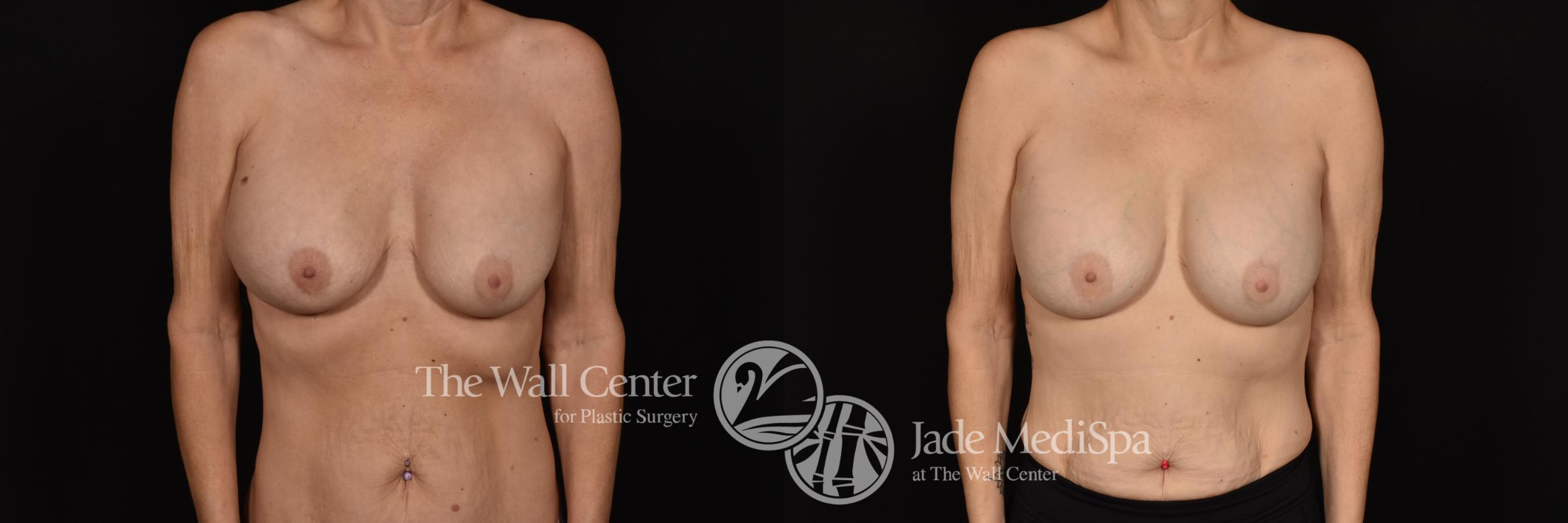 Before & After Breast Implant Exchange Case 1162 Front View in Shreveport, LA