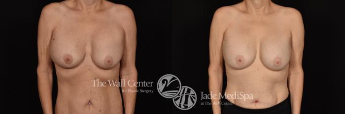 Before & After Breast Implant Exchange Case 1162 Front View in Shreveport, LA