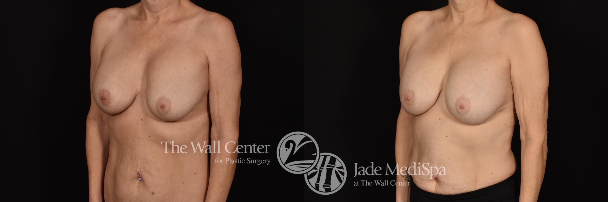 Before & After Breast Implant Exchange Case 1162 Left Oblique View in Shreveport, LA