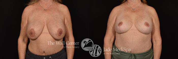 Before & After Breast Augmentation with Lift Case 1180 Front View in Shreveport, LA